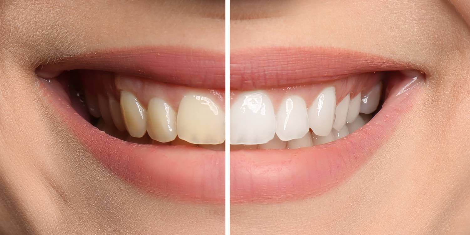 Smiling woman before and after teeth whitening